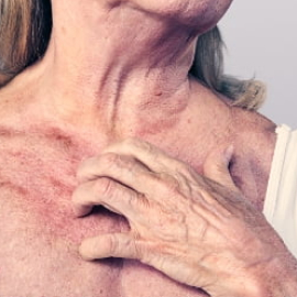 A close up Image of woman scratching her upper chest, it looks visibly uncomfortable.