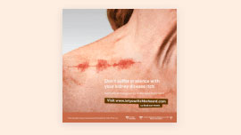  An image of a poster showing a female chest with a noticeable, graphical representation of itchy skin